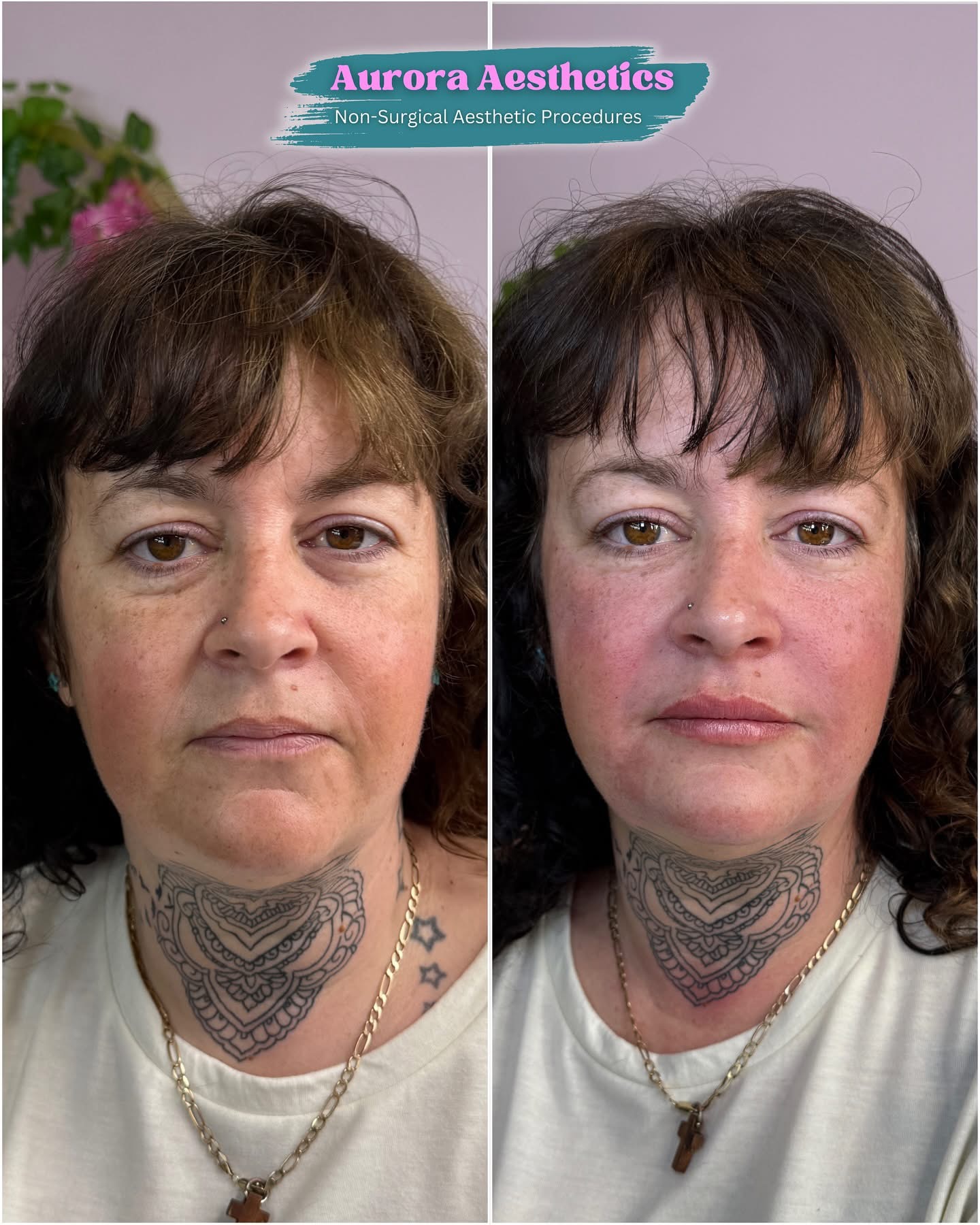 Client before and after treatment, front view