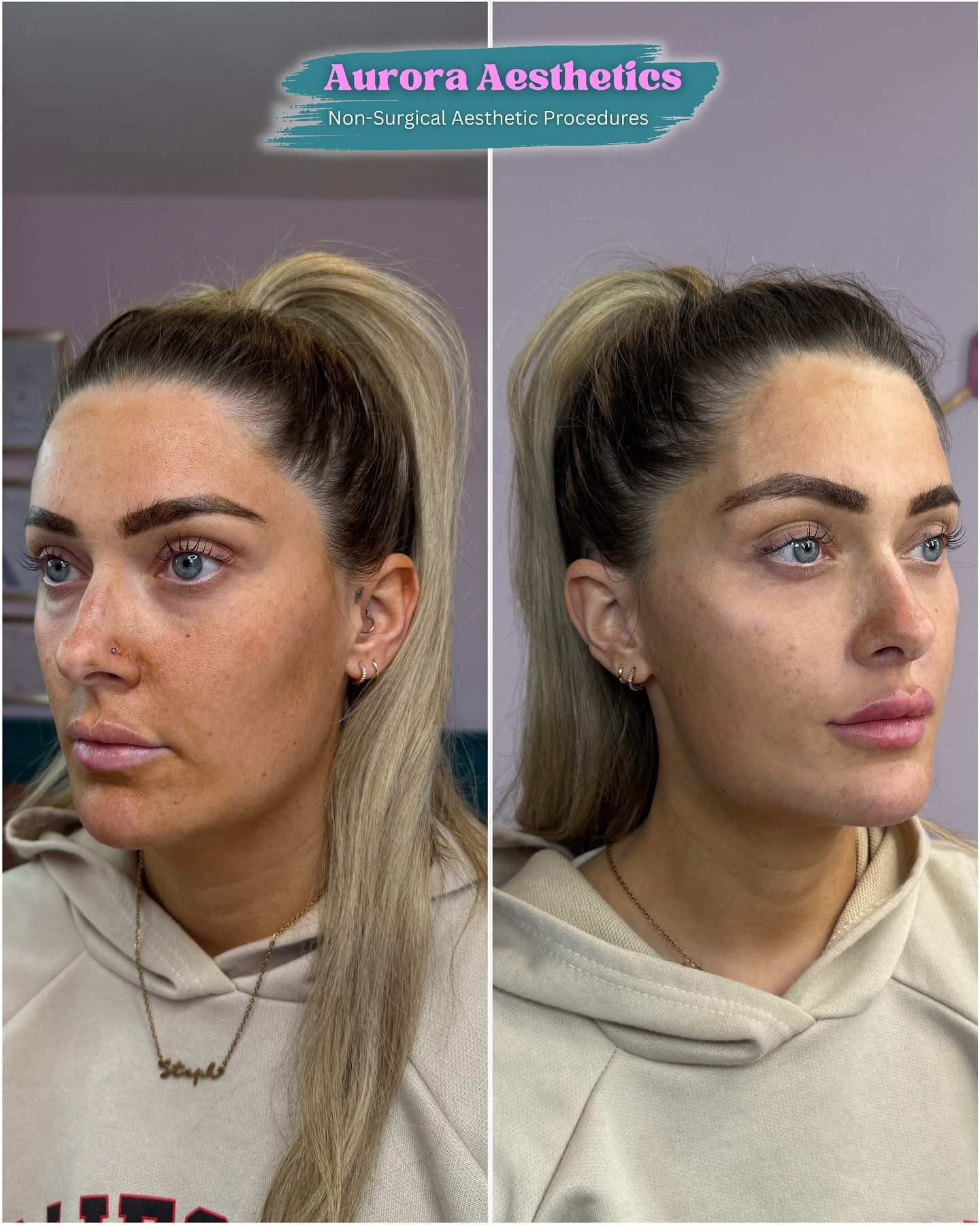 Client before and after treatment, side profile
