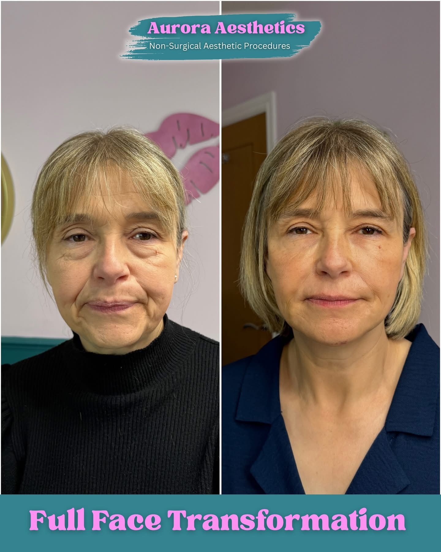 Full Face Transformation, before and after