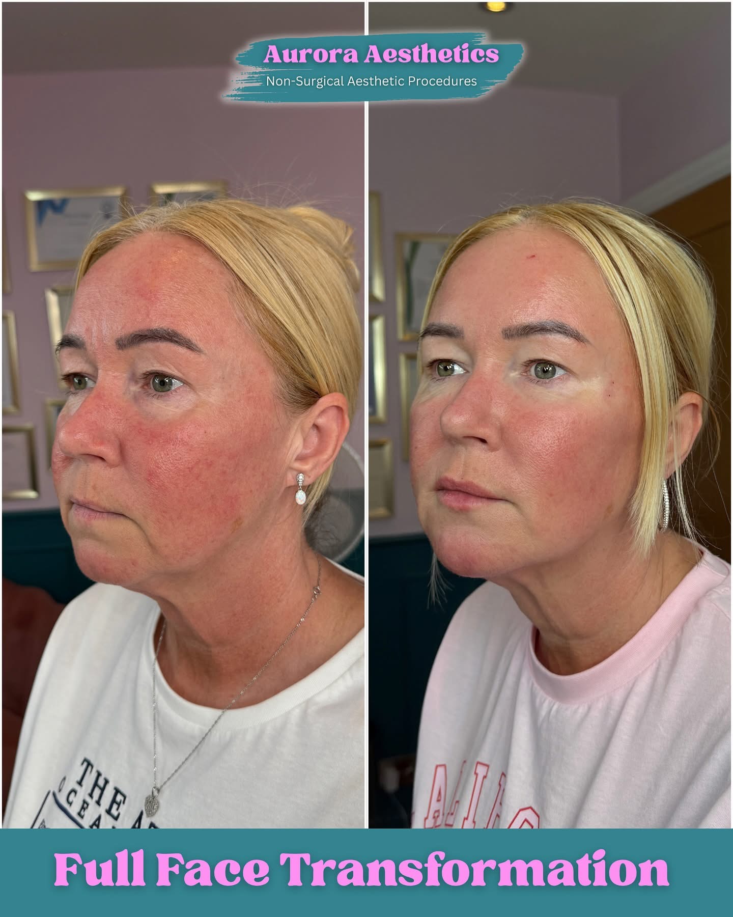 Full Face Transformation, before and after, front view