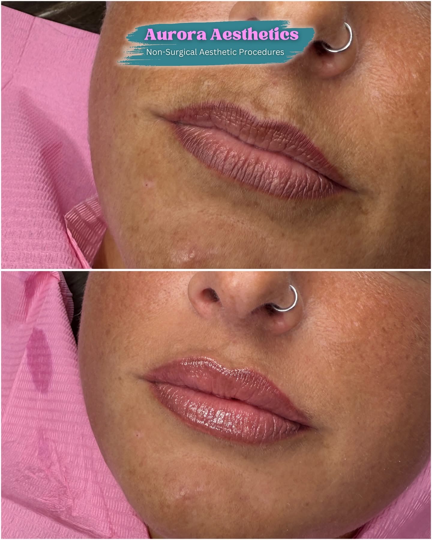 Lip filler, before and after