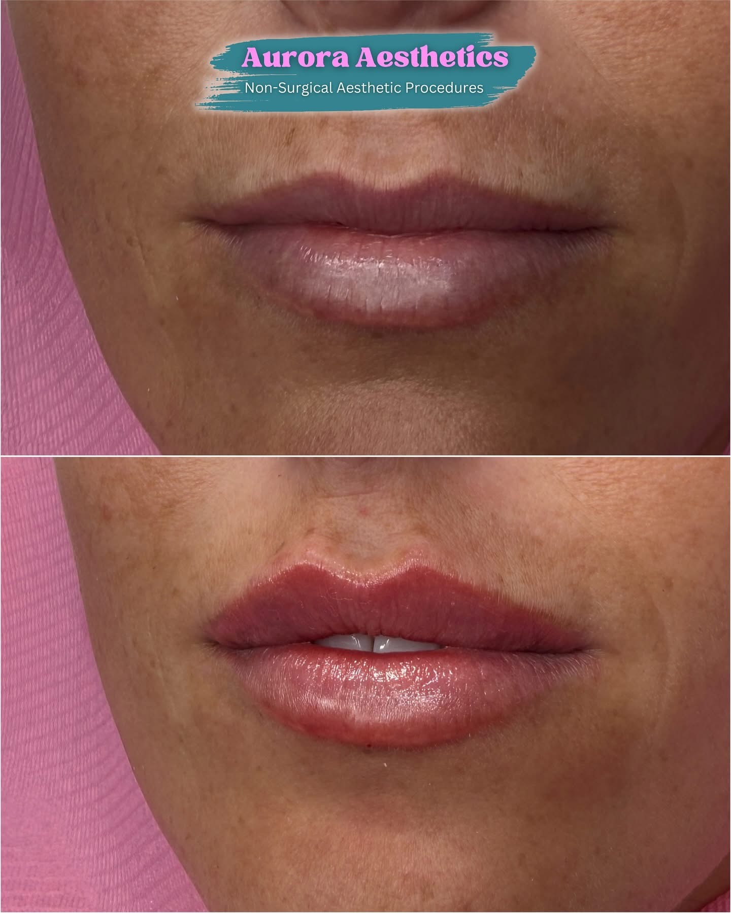 Lip filler, before and after, close up