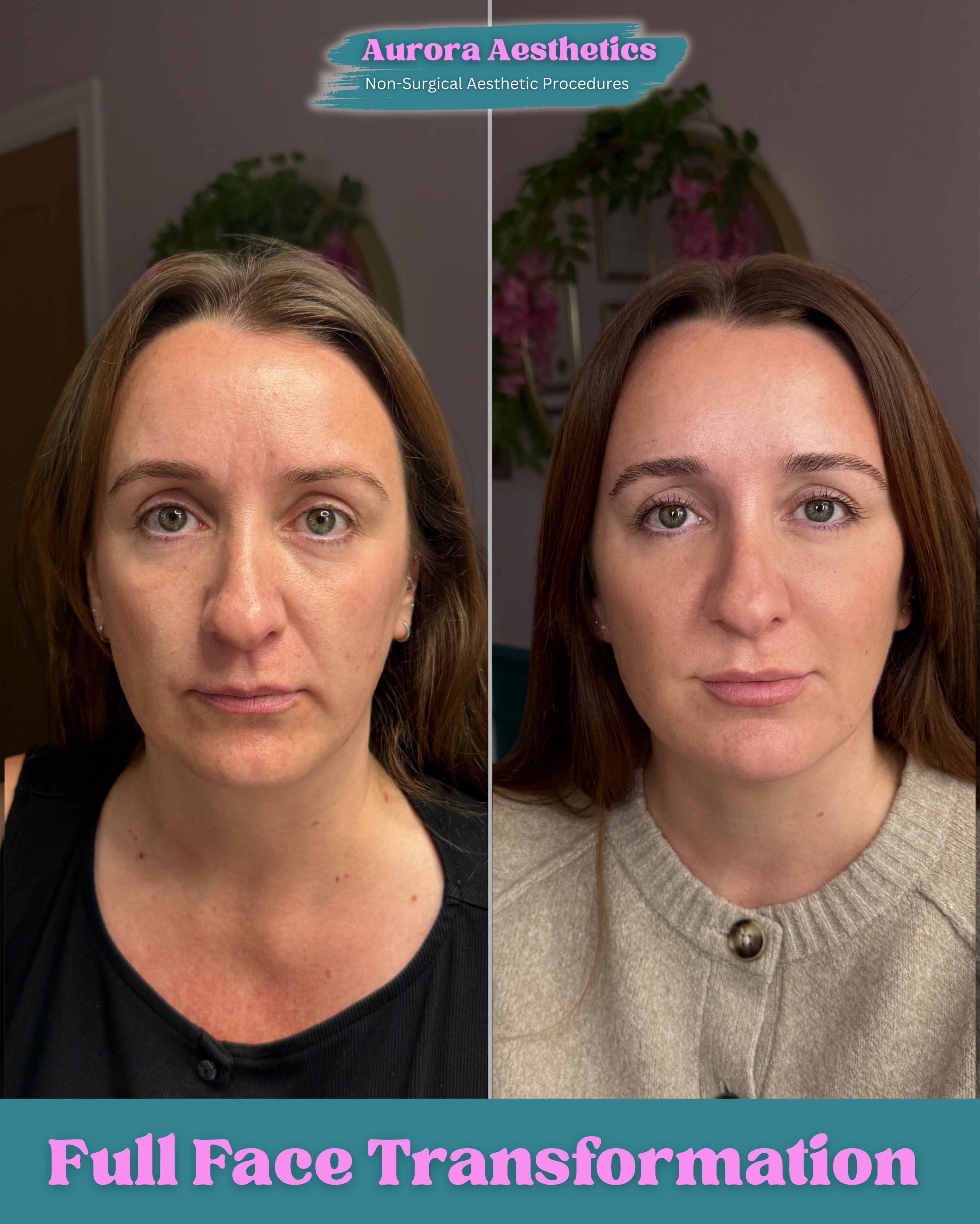 Full Face Transformation, before and after