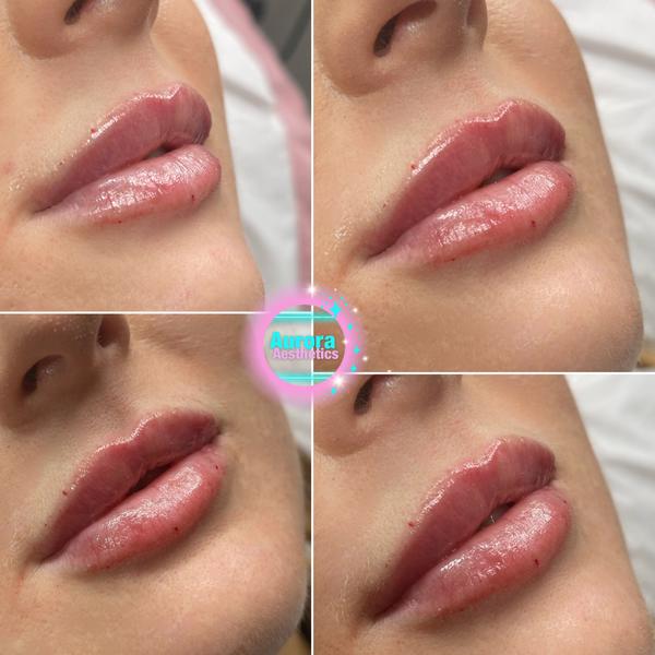 Lip filler, before and after from four angles