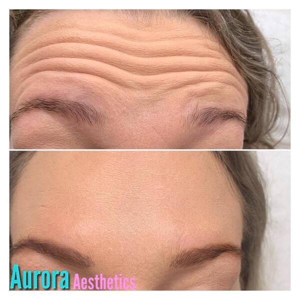 Forehead lines before and after anti-wrinkle treatment