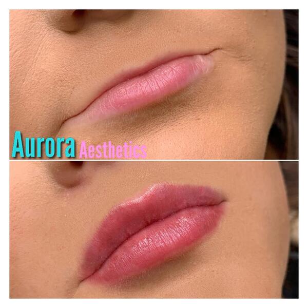 Lips before and after, side view