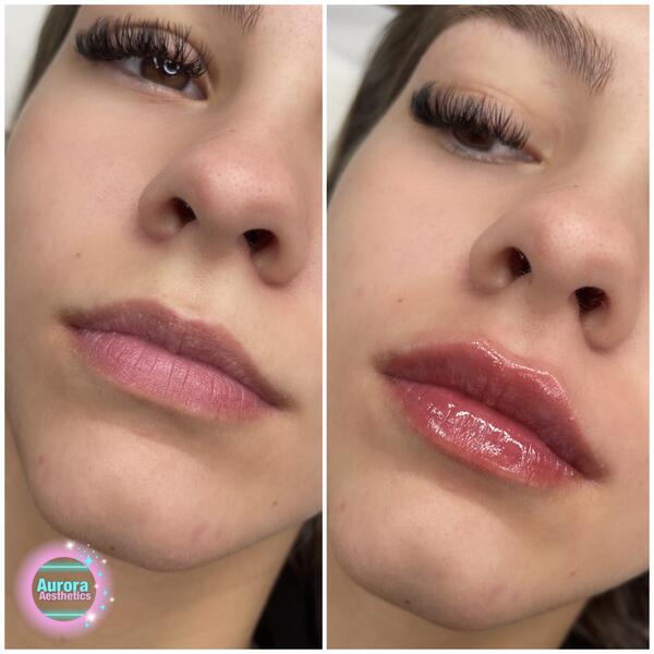 Lips before and after, three-quarter view